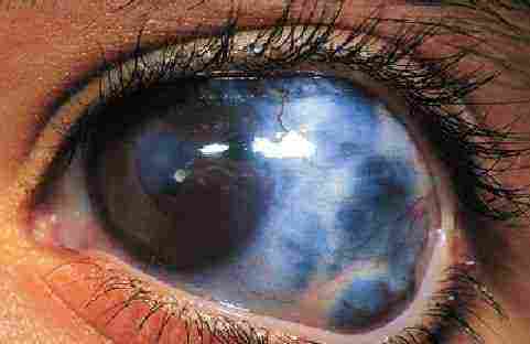 المياه الزرقاء في العين وأعراضها