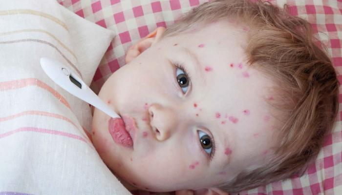 علاج الطفح الجلدي عند الأطفال بعد الحمى