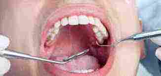 كم عدد اسنان الانسان البالغ