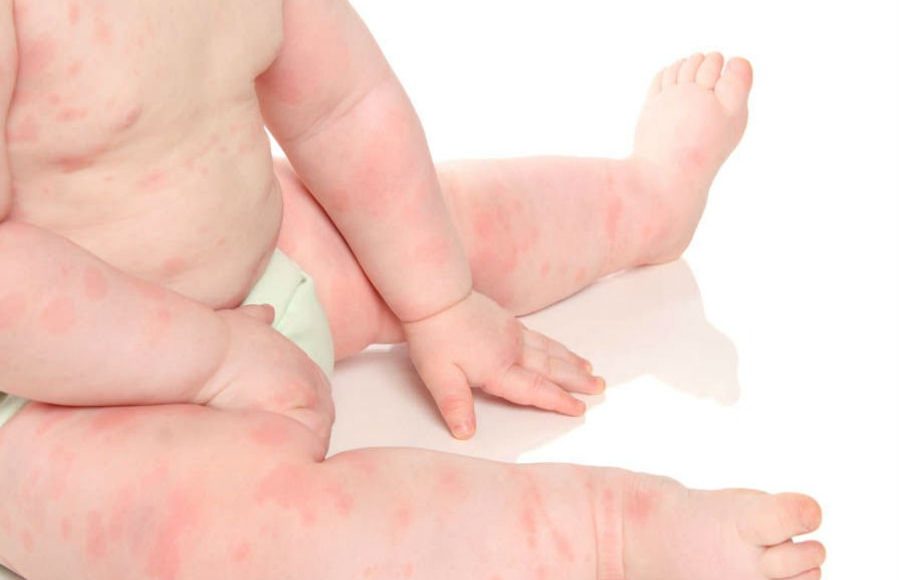 أسباب حساسية الجلد المفاجئة عند الأطفال