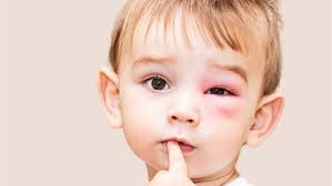 علاج كدمات العين عند الأطفال 